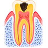 象牙質まで進んだむし歯（C2）