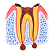 歯根だけ残ったむし歯（C4）